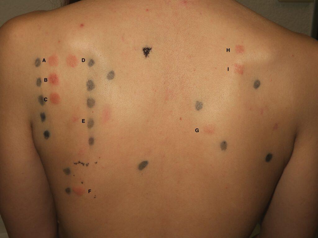 This image demonstrates allergy patch test results performed due to vulval dermatitis